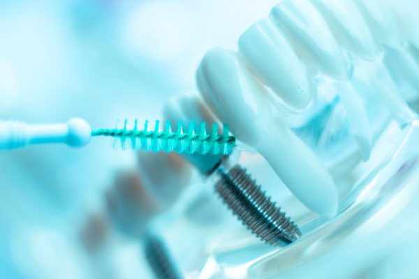 cleaning dental implants