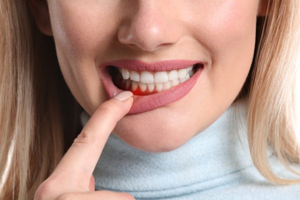 woman showing her red, swollen gums