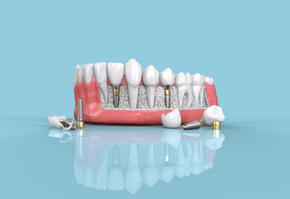 prosthetic dental implants