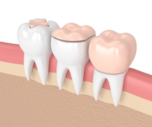 inlay, onlay, dental crown on teeth