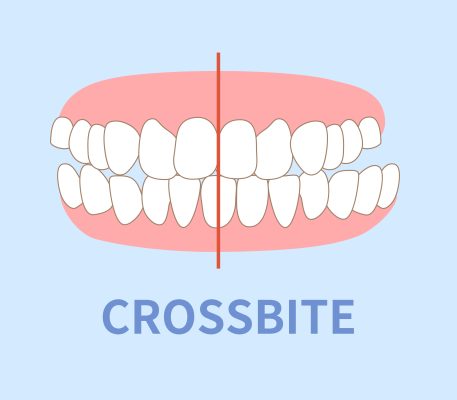 image of what a crossbite looks like