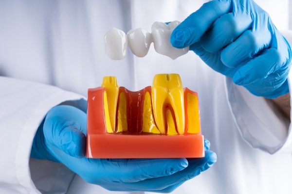 dental bridge